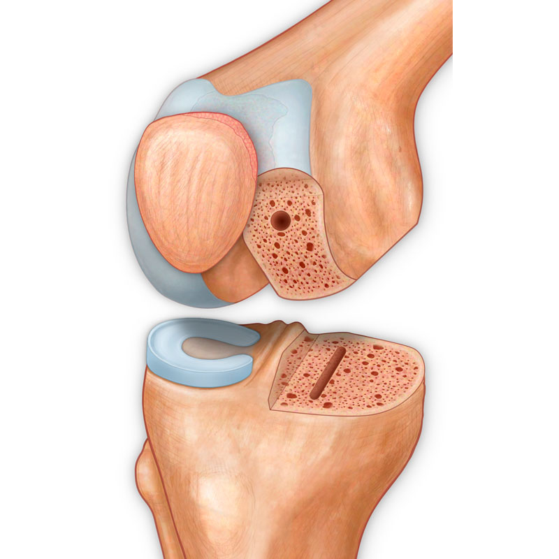 Unicompartmental Arthroplasty