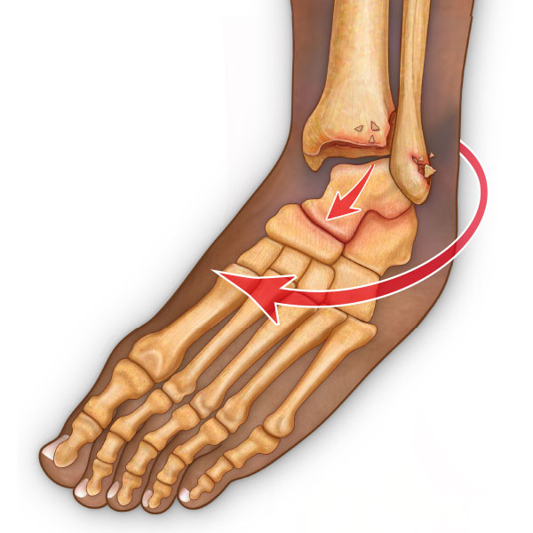 Dislocated Ankle