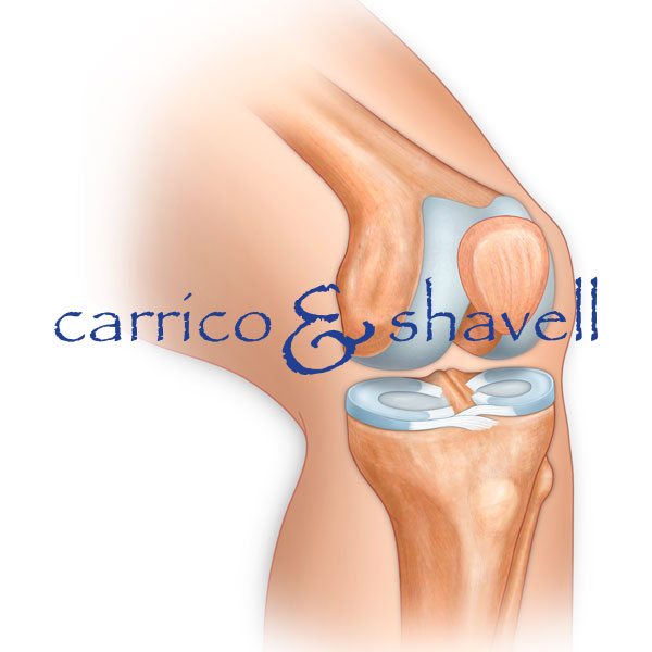 Articular Surfaces of Femur and Tibia - Left Knee