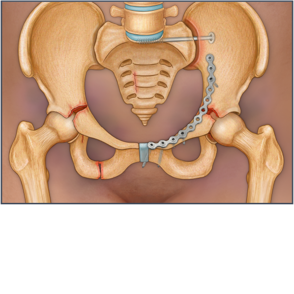 Pelvic Fractures with Plate and Screw