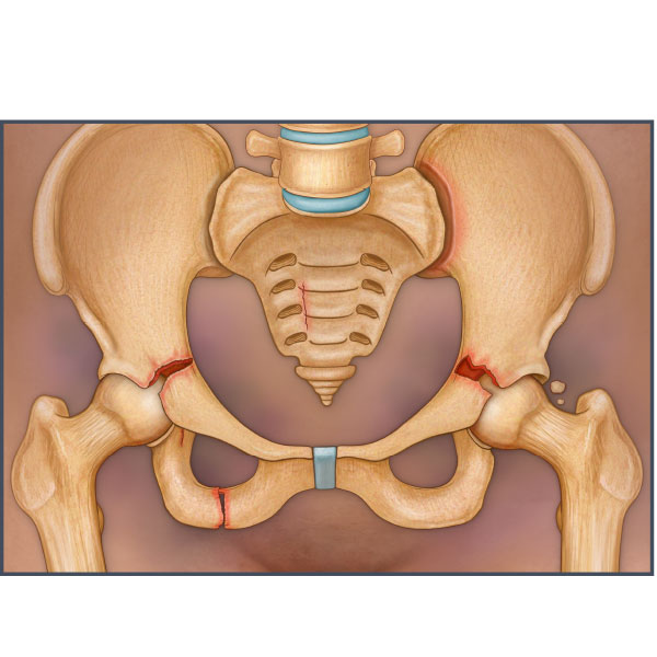 Pelvic Fractures
