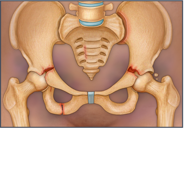 Pelvic Fractures