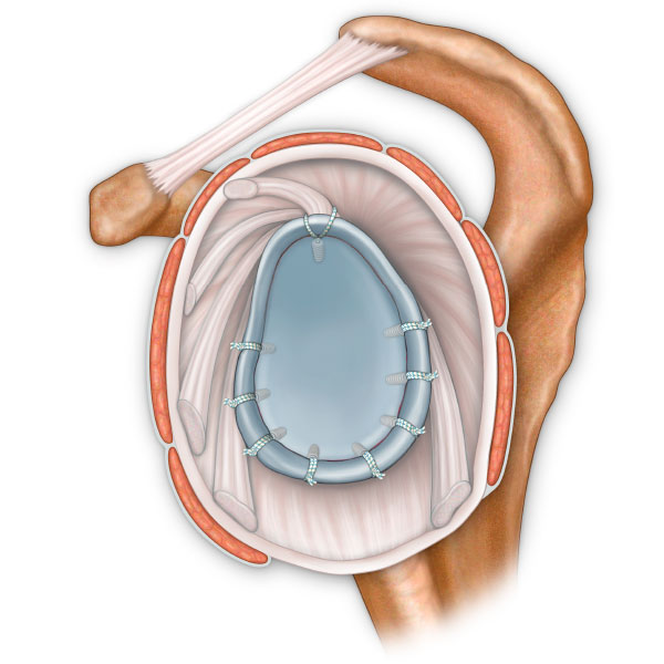Rotator Cuff Bankart Anchor Repair