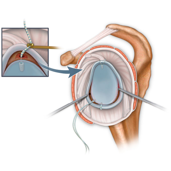 Rotator Cuff Bankart Tear Repair