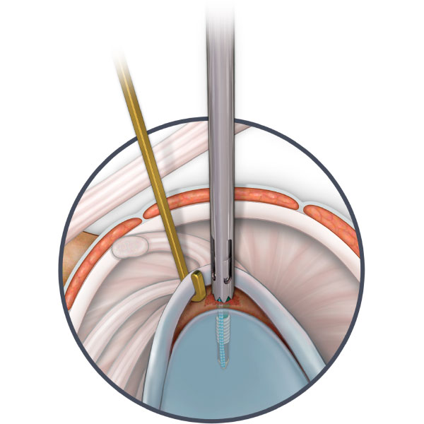 Rotator Cuff SLAP Repair