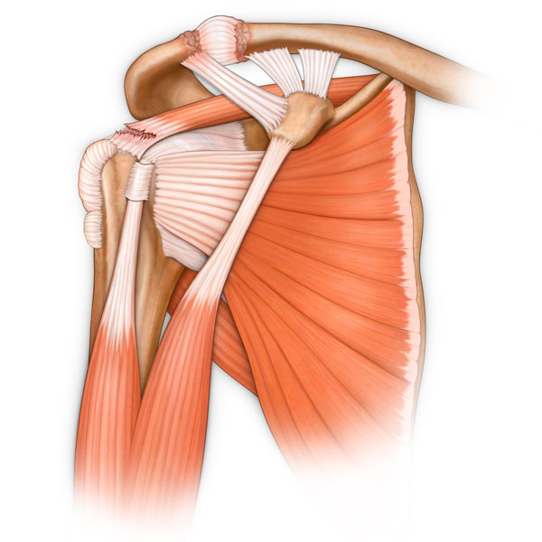 Shoulder Anatomy with a Supraspinatus Tear