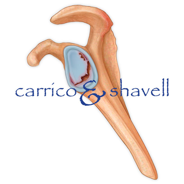 Torn Labrum