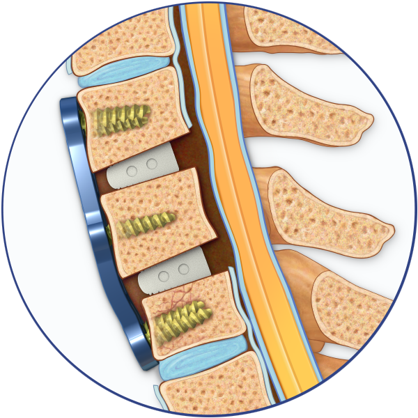 Anterior Cervical Plate