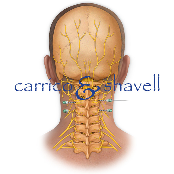 Medial Nerve Block