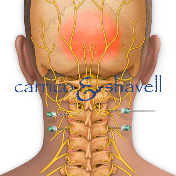 Nerve Block for Occipital Headache