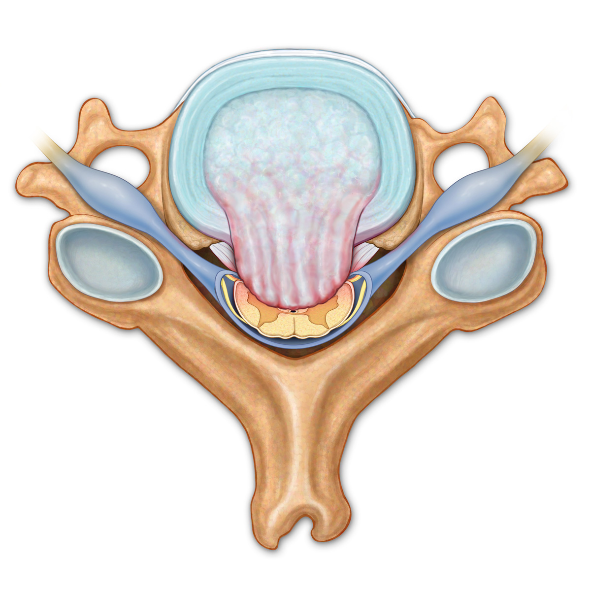 Herniated Cervical Disc