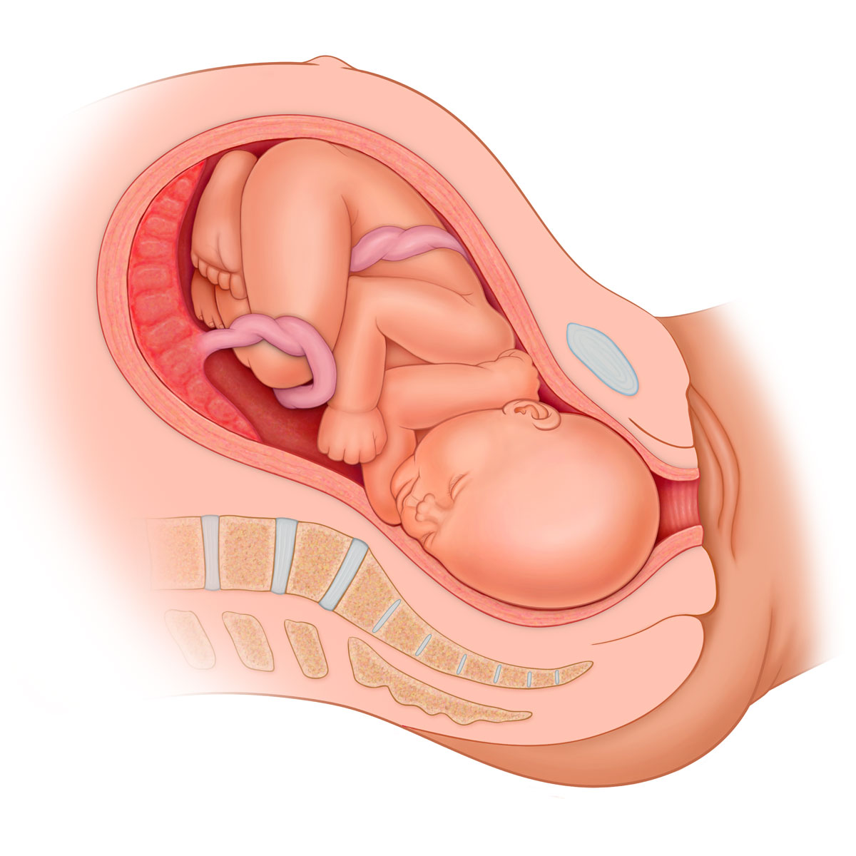 Right Occiput Posterior Delivery