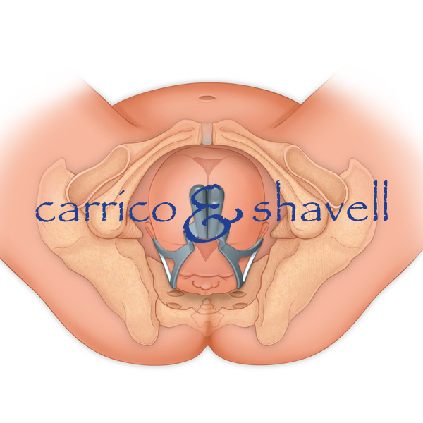 Right Occiput Anterior Presentation
