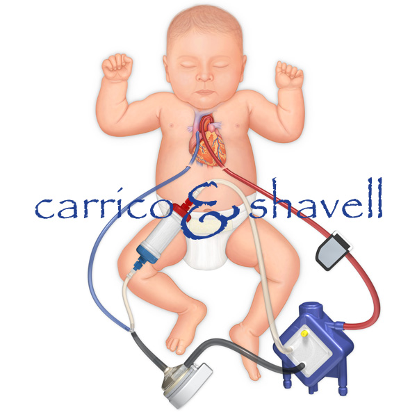 Pediatric Heart Bypass Device